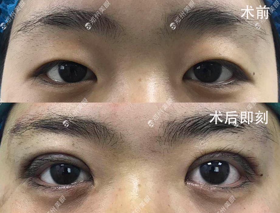 最新双眼皮手术技巧，创新割双眼皮方法解析